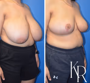 Breast reduction before and after photo, front view