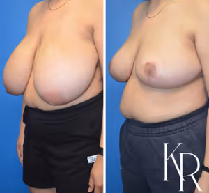 Breast reduction before and after photo, front view