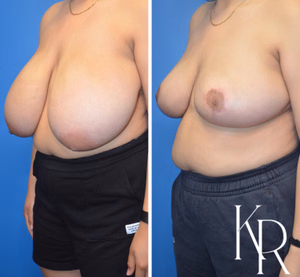 Breast reduction before and after photo, front view