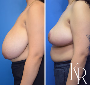 Breast reduction before and after photo, side view