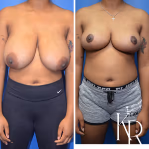 Breast reduction before and after photo, front view