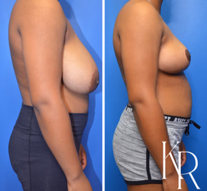 Breast reduction before and after photo, side view