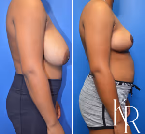 Breast reduction before and after photo, side view