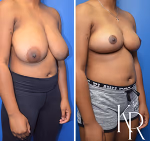 Breast reduction before and after photo, front view