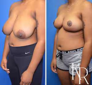 Breast reduction before and after photo, front view