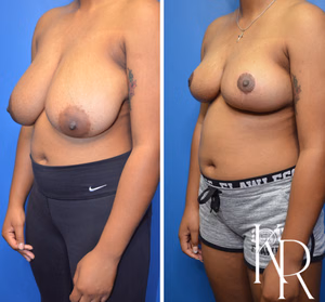 Breast reduction before and after photo, front view