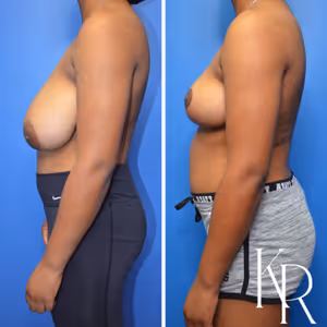 Breast reduction before and after photo, side view