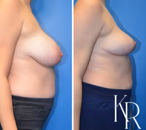 Breast reduction before and after photo, side view