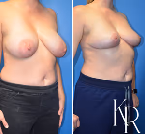 Breast reduction before and after photo, front view