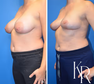 Breast reduction before and after photo, front view