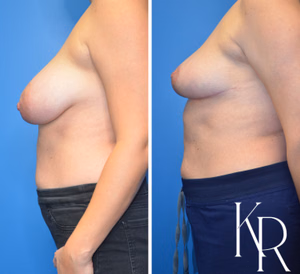 Breast reduction before and after photo, side view