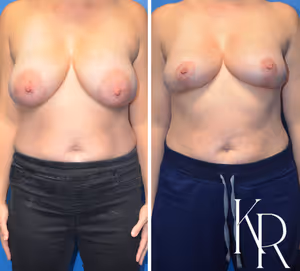 Breast reduction before and after photo, front view