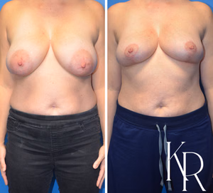 Breast reduction before and after photo, front view