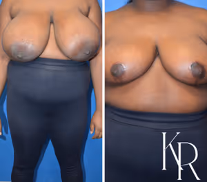 Breast reduction before and after photo, front view