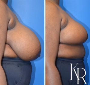 Breast reduction before and after photo, side view
