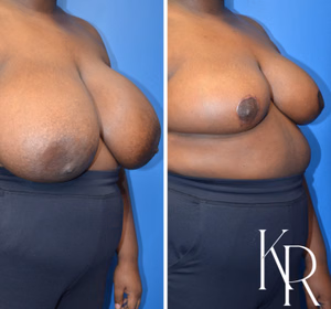 Breast reduction before and after photo, side view