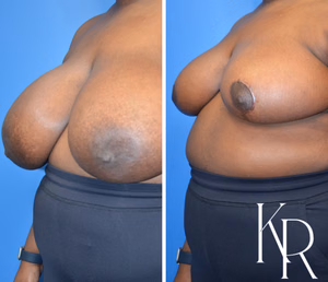 Breast reduction before and after photo, side view