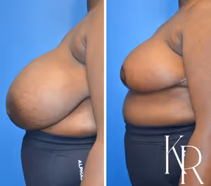 Breast reduction before and after photo, side view