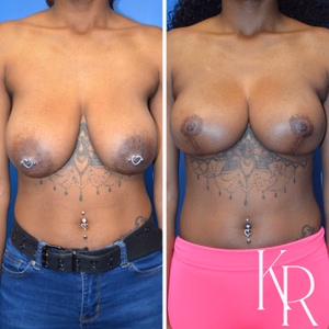 Breast reduction before and after photo, side view