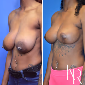 Breast reduction before and after photo, side view