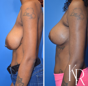Breast reduction before and after photo, side view