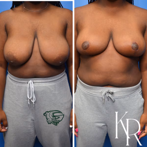 Breast reduction before and after photo, side view