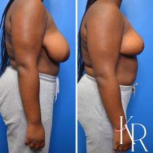 Breast reduction before and after photo, front view