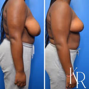 Breast reduction before and after photo, front view