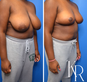 Breast reduction before and after photo, front view