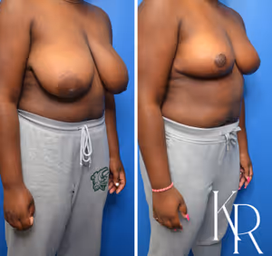 Breast reduction before and after photo, front view