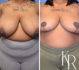 Breast reduction before and after photo, side view