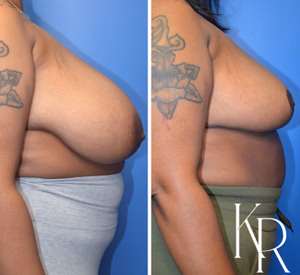 Breast reduction before and after photo, side view