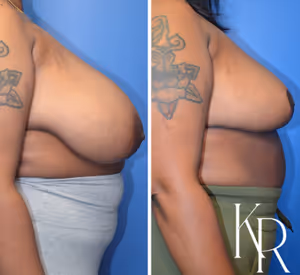 Breast reduction before and after photo, side view