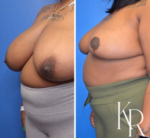 Breast reduction before and after photo, front view