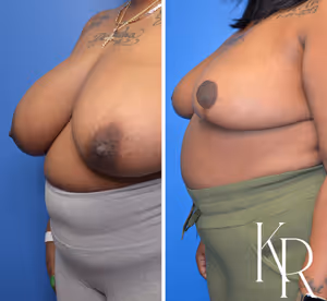 Breast reduction before and after photo, front view