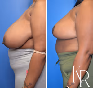 Breast reduction before and after photo, front view