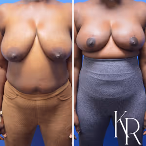 Breast reduction before and after photo, side view