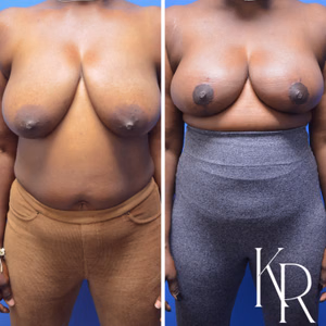 Breast reduction before and after photo, side view