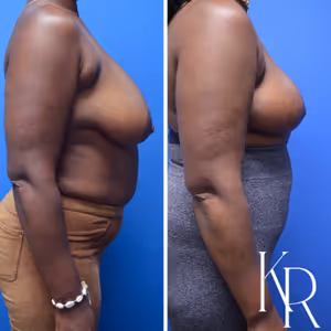 Breast reduction before and after photo, side view