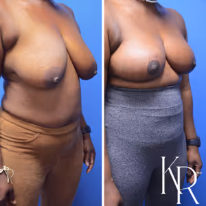 Breast reduction before and after photo, side view