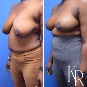 Breast reduction before and after photo, side view