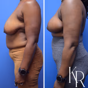 Breast reduction before and after photo, side view