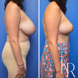Breast reduction before and after photo, side view