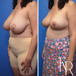 Breast reduction before and after photo, front view