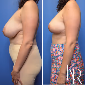 Breast reduction before and after photo, front view