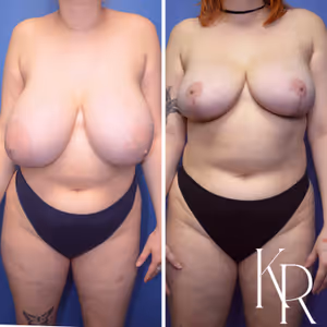 Breast reduction before and after photo, front view
