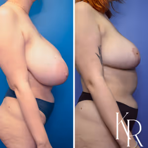 Breast reduction before and after photo, side view