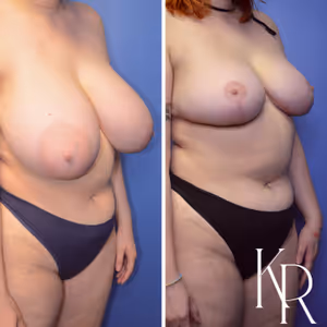 Breast reduction before and after photo, front view