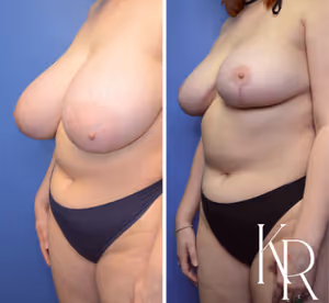 Breast reduction before and after photo, side view