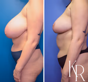 Breast reduction before and after photo, front view